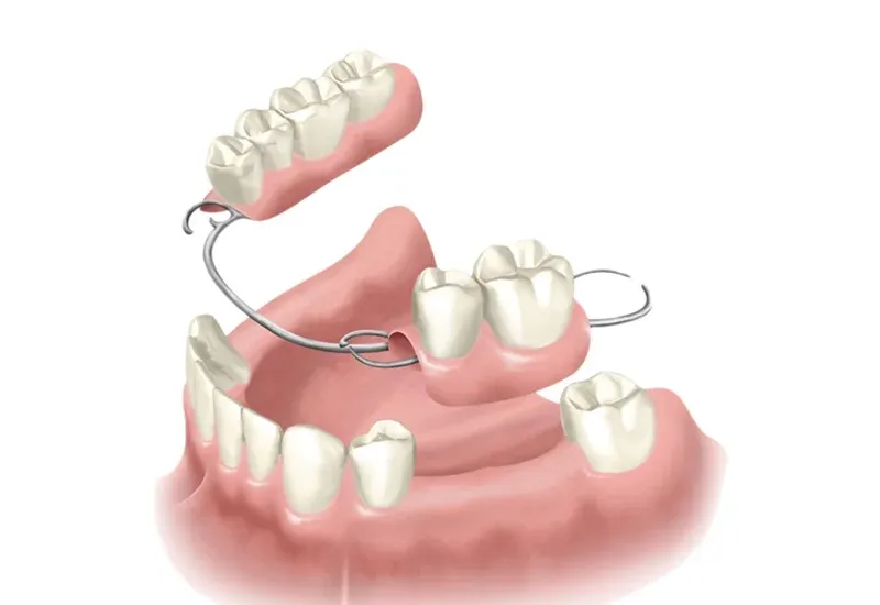 7 Types of Dentures Explained: Find the Best Denture Option for You