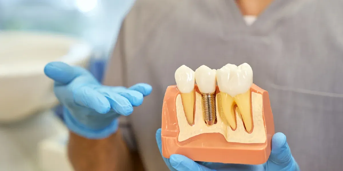 Common Myths About Dental Implants Explained