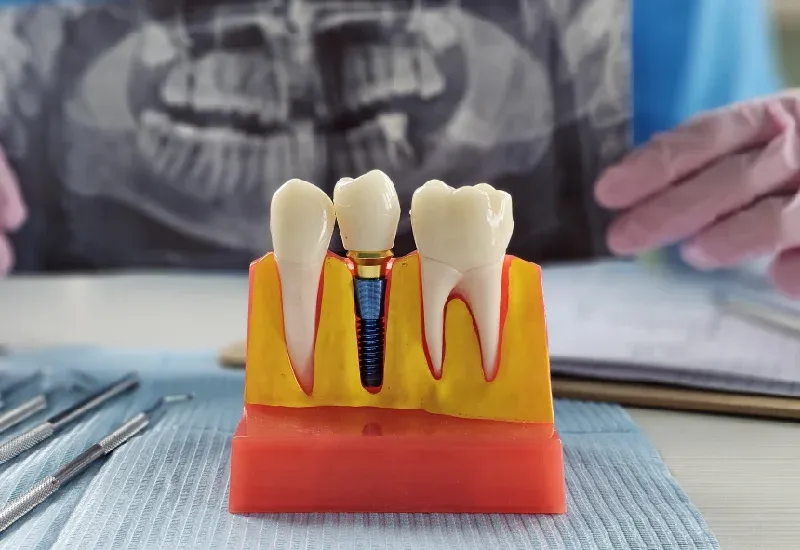 Common Myths About Dental Implants Explained