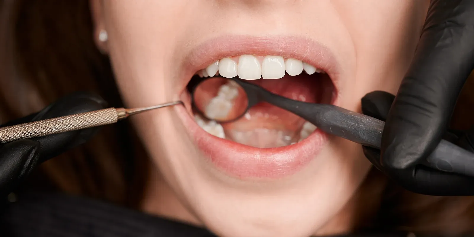 How Much Does a Dental Filling Cost in San Francisco? A 2025 Pricing and Procedure Guide