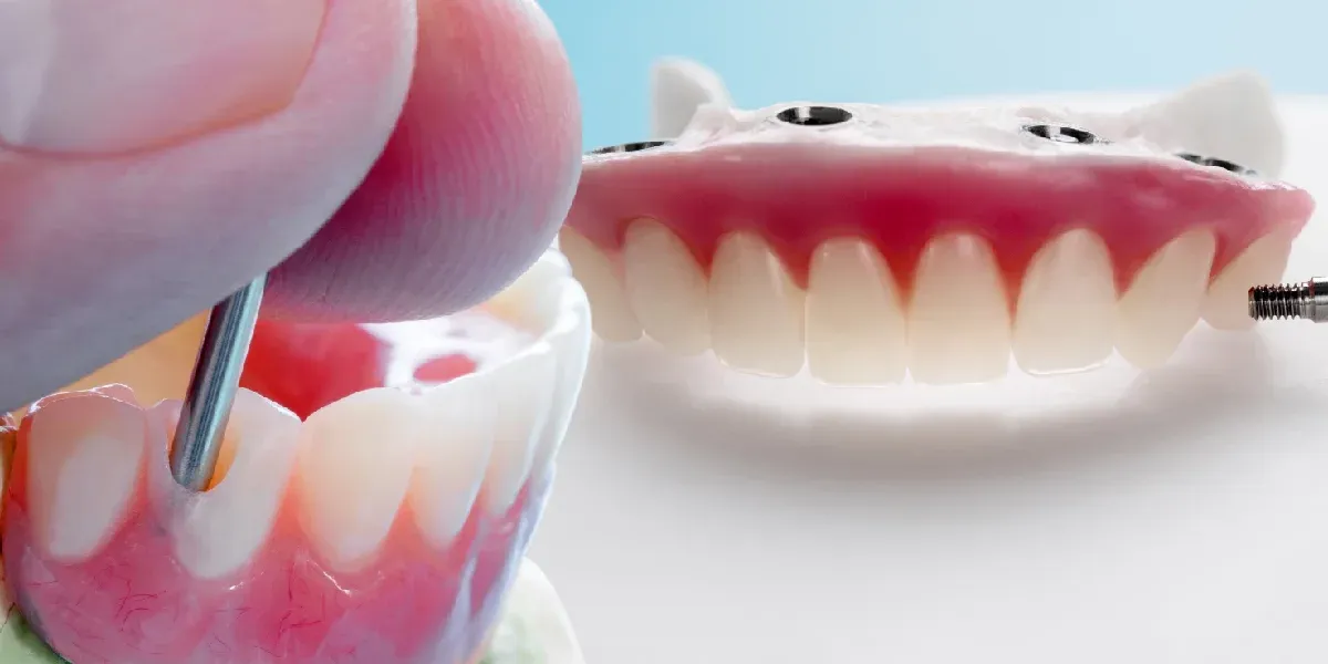 Implant Supported Dentures for Better Stability
