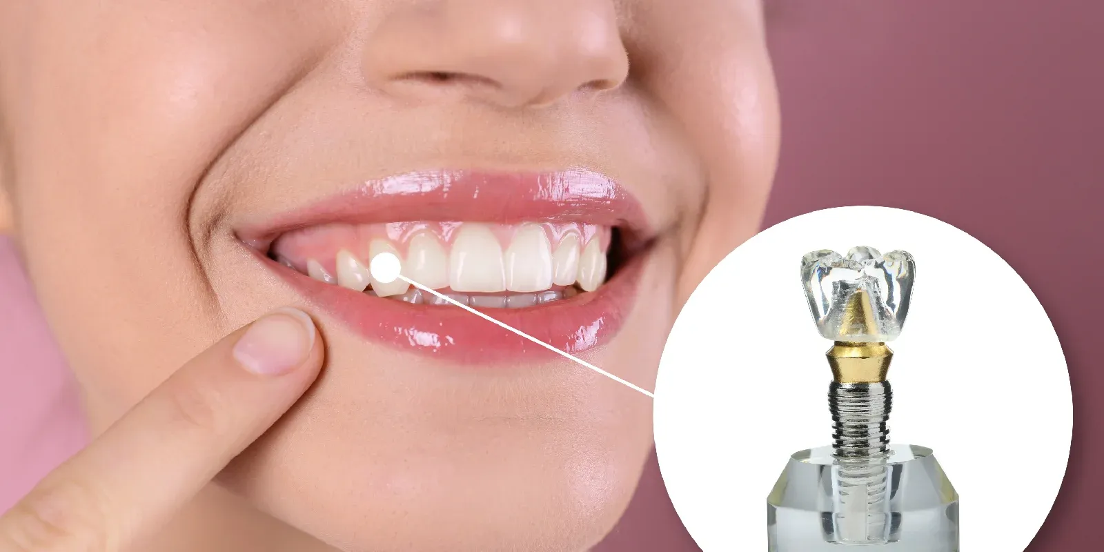 Same-Day Dental Implant - What Patients Should Know
